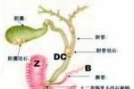 膽道結石 膽道結石癥