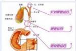 膽道結石 膽道結石癥