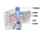 門靜脈血栓形成 I81.X02 門靜脈血栓癥