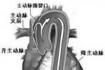 主動脈夾層 主動脈夾層動脈瘤 主動脈夾層分離