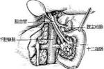 主動脈夾層 主動脈夾層動脈瘤 主動脈夾層分離