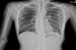自發性氣胸 J93.101 Spontaneous pneumothorax