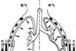 張力性氣胸 J93.001 壓力性氣胸 活瓣性氣胸