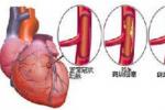 血胸 J94.202 胸膜腔積血 胸腔積血