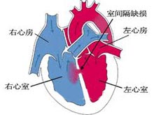 心室間隔缺損 室間隔缺損