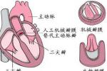 風濕性二尖瓣狹窄 I05.001 風濕性心臟瓣膜病