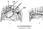 創傷性膈疝 S27.801 外傷性膈疝