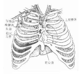 創傷性血胸 S27.101 外傷性血胸