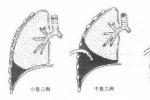 創傷性血胸 S27.101 外傷性血胸