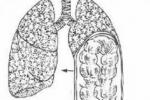 肺疝 J98.452 