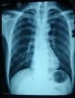 單側肺氣腫 J43.052 單側透明肺 先天性肺囊腺樣畸形 先天性肺葉