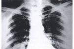 肺炎性假瘤 J98.409 肺內良性腫塊