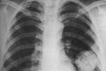 肺錯構瘤 Q85.901 