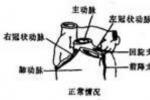 冠狀動脈異位起源 冠狀動脈起源異常