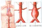 老年人主動脈瘤 老年主動脈瘤