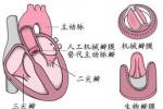 聯合瓣膜病變