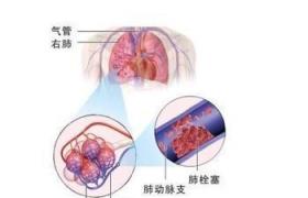 空氣栓塞 空氣栓塞癥 氣泡栓塞 氣泡栓塞病 aeroembolism