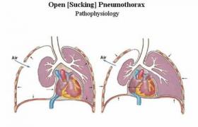 開放性氣胸 S27.011 