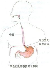 食管裂孔疝 裂孔疝