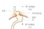 食管裂孔疝 裂孔疝
