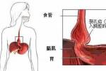 食管裂孔疝 裂孔疝