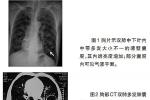 先天性肺囊腫 Q33.001 肺囊腫