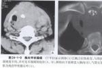 胸內甲狀腺腫 縱隔甲狀腺腫