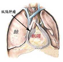 胸腺囊腫 E32.802 