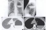 先天性支氣管肺囊腫 先天性囊性支氣管擴張先天性支氣管源性囊