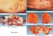 胸部放線菌病 A42.851 