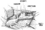 先天性主動脈縮窄 Q25.101 先天主動脈縮窄