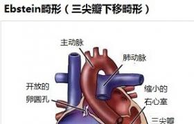 先天性二尖瓣畸形