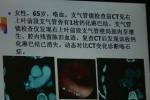 支氣管結石癥 支氣管結石