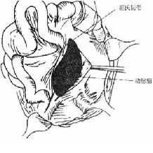 炎癥性腹主動脈瘤 炎性腹主動脈瘤