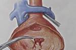 炎癥性腹主動脈瘤 炎性腹主動脈瘤
