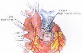 主-肺動脈隔缺損 主-肺動脈窗