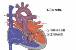 右心室雙出口