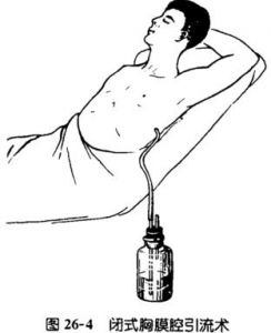閉合性氣胸