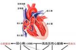 老年人冠心病