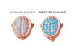 癲癇 G40.901 羊癲瘋 羊角風 羊羔瘋 羊癇風