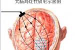 癲癇 G40.901 羊癲瘋 羊角風 羊羔瘋 羊癇風