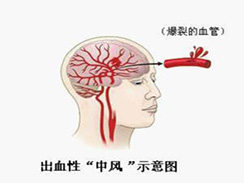 中風 腦卒中