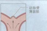 中風 腦卒中