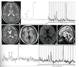 腦震蕩 S06.001 concussion of brain