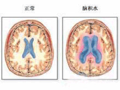 腦積水 G91.901 顱內腦積水