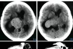 腦積水 G91.901 顱內腦積水