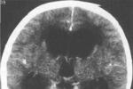 腦積水 G91.901 顱內腦積水
