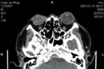 眩暈 R42.X01 前庭系統性眩暈 前庭性眩暈 真性眩暈