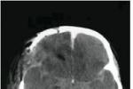 腦血管痙攣 Cerebral angiospasm