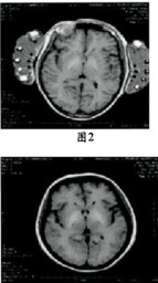 肝性腦病 HE 肝性昏迷 肝昏迷 肝腦變性綜合征 門體分流形性腦病